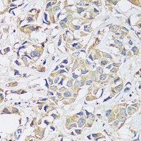 Immunohistochemistry of paraffin-embedded Human breast cancer using BLOC1S3 Polyclonal Antibody at dilution of 1:100 (40x lens) .
