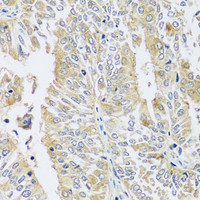 Immunohistochemistry of paraffin-embedded Human uterine cancer using BLOC1S3 Polyclonal Antibody at dilution of 1:100 (40x lens) .