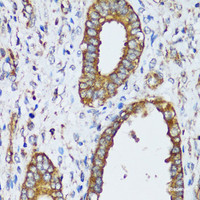 Immunohistochemistry of paraffin-embedded Human uterine cancer using MAPK1/MAPK3 Polyclonal Antibody at dilution of 1:200 (40x lens) .
