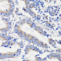Immunohistochemistry of paraffin-embedded Human colon carcinoma using DEPDC6 Polyclonal Antibody at dilution of 1:200 (40x lens) .