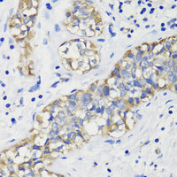 Immunohistochemistry of paraffin-embedded Human breast cancer using DEPDC6 Polyclonal Antibody at dilution of 1:200 (40x lens) .