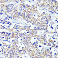 Immunohistochemistry of paraffin-embedded Human breast cancer using CNR2 Polyclonal Antibody at dilution of 1:150 (40x lens) .