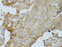 Immunohistochemistry of paraffin-embedded Human breast cancer using GGT1 Polyclonal Antibody at dilution of 1:100 (40x lens) .