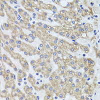 Immunohistochemistry of paraffin-embedded Human liver damage using ACP1 Polyclonal Antibody at dilution of 1:100 (40x lens) .