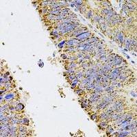 Immunohistochemistry of paraffin-embedded Human colon carcinoma using ALDH1A1 Polyclonal Antibody at dilution of 1:100 (40x lens) .