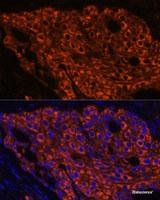 Immunofluorescence analysis of Human lung cancer using SFTPC Polyclonal Antibody at dilution of 1:100 (40x lens) . Blue: DAPI for nuclear staining.