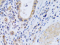 Immunohistochemistry of paraffin-embedded Human gastric cancer using PTGIR Polyclonal Antibody at dilution of 1:200 (40x lens) .