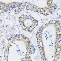 Immunohistochemistry of paraffin-embedded Human colon carcinoma using PDHA1 Polyclonal Antibody at dilution of 1:200 (40x lens) .