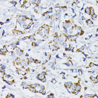 Immunohistochemistry of paraffin-embedded Human mammary cancer using PDHA1 Polyclonal Antibody at dilution of 1:200 (40x lens) .
