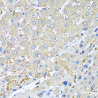 Immunohistochemistry of paraffin-embedded Human liver cancer using PPBP Polyclonal Antibody at dilution of 1:100 (40x lens) .