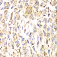 Immunohistochemistry of paraffin-embedded Human lung cancer using CD151 Polyclonal Antibody at dilution of 1:200 (40x lens) .