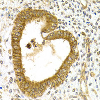 Immunohistochemistry of paraffin-embedded Human adenomyosis using RAB27A Polyclonal Antibody at dilution of 1:200 (40x lens) .