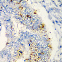 Immunohistochemistry of paraffin-embedded Human colon carcinoma using TIRAP Polyclonal Antibody at dilution of 1:200 (40x lens) .