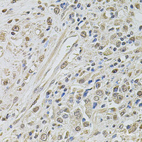 Immunohistochemistry of paraffin-embedded Human prostate cancer using SMARCC2 Polyclonal Antibody at dilution of 1:100 (40x lens) .