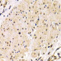 Immunohistochemistry of paraffin-embedded Human stomach cancer using TMPRSS2 Polyclonal Antibody at dilution of 1:200 (40x lens) .