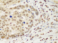 Immunohistochemistry of paraffin-embedded Human esophageal cancer using HDAC2 Polyclonal Antibody at dilution of 1:100 (40x lens) .