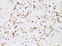 Immunohistochemistry of paraffin-embedded Human liver cancer using IKK beta Polyclonal Antibody at dilution of 1:100 (40x lens) .