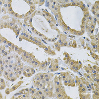 Immunohistochemistry of paraffin-embedded Human thyroid cancer using NCF4 Polyclonal Antibody at dilution of 1:100 (40x lens) .