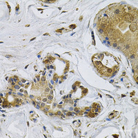 Immunohistochemistry of paraffin-embedded Human breast cancer using NCF4 Polyclonal Antibody at dilution of 1:100 (40x lens) .