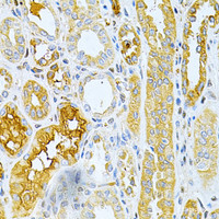 Immunohistochemistry of paraffin-embedded Human kidney cancer using TNFRSF11B Polyclonal Antibody at dilution of 1:200 (40x lens) .