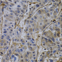 Immunohistochemistry of paraffin-embedded Human liver cancer using CD31 Polyclonal Antibody at dilution of 1:100 (40x lens) .