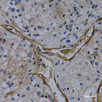 Immunohistochemistry of paraffin-embedded Human kidney damage using CD31 Polyclonal Antibody at dilution of 1:100 (40x lens) .