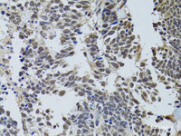 Immunohistochemistry of paraffin-embedded Human lung cancer using LKB1 Polyclonal Antibody at dilution of 1:100 (40x lens) .