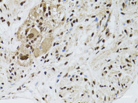 Immunohistochemistry of paraffin-embedded Human colon carcinoma using LKB1 Polyclonal Antibody at dilution of 1:100 (40x lens) .