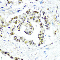Immunohistochemistry of paraffin-embedded Human lung cancer using SUMO1 Polyclonal Antibody at dilution of 1:200 (40x lens) .