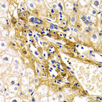 Immunohistochemistry of paraffin-embedded Human liver damage using CFH Polyclonal Antibody at dilution of 1:200 (40x lens) .