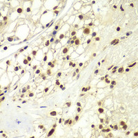 Immunohistochemistry of paraffin-embedded Human kidney cancer using RPA2 Polyclonal Antibody at dilution of 1:100 (40x lens) .