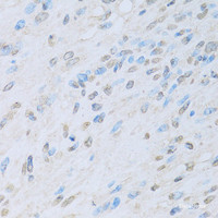 Immunohistochemistry of paraffin-embedded Human liver cancer using KAT2A Polyclonal Antibody at dilution of 1:100 (40x lens) .