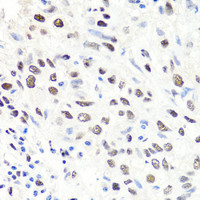 Immunohistochemistry of paraffin-embedded Human lung cancer using CBX1 Polyclonal Antibody at dilution of 1:100 (40x lens) .