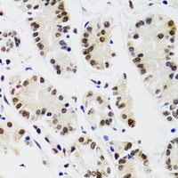 Immunohistochemistry of paraffin-embedded Human gastric cancer using EDF1 Polyclonal Antibody at dilution of 1:100 (40x lens) .