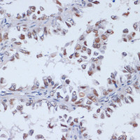 Immunohistochemistry of paraffin-embedded Human lung cancer using DNMT3L Polyclonal Antibody at dilution of 1:100 (40x lens) .