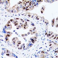 Immunohistochemistry of paraffin-embedded Human gastric cancer using UHRF1 Polyclonal Antibody at dilution of 1:100 (40x lens) .