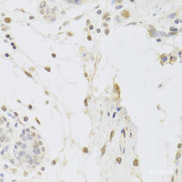 Immunohistochemistry of paraffin-embedded Human breast using HAUSP / USP7 Polyclonal Antibody at dilution of 1:100 (40x lens) .