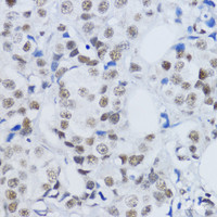 Immunohistochemistry of paraffin-embedded Human mammary cancer using DiMethyl-Histone H3-K79 Polyclonal Antibody at dilution of 1:200 (40x lens) .