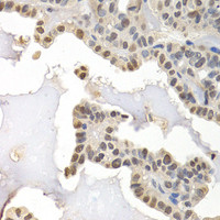 Immunohistochemistry of paraffin-embedded Human thyroid cancer using GTF2F1 Polyclonal Antibody at dilution of 1:200 (40x lens) .