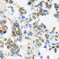 Immunohistochemistry of paraffin-embedded Human lung cancer using APOBEC3F Polyclonal Antibody at dilution of 1:100 (40x lens) .