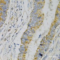 Immunohistochemistry of paraffin-embedded Human colon carcinoma using GNAO1 Polyclonal Antibody at dilution of 1:100 (40x lens) .