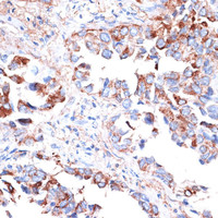 Immunohistochemistry of paraffin-embedded Human lung cancer using TIM-3/HAVCR2 Polyclonal Antibody at dilution of 1:200 (40x lens) .