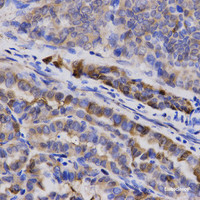 Immunohistochemistry of paraffin-embedded Human thyroid cancer using SNCG Polyclonal Antibody at dilution of 1:200 (40x lens) .