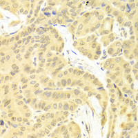 Immunohistochemistry of paraffin-embedded Human thyroid cancer using CFLAR Polyclonal Antibody at dilution of 1:100 (40x lens) .