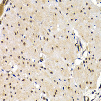Immunohistochemistry of paraffin-embedded Human gastric cancer using IRF2 Polyclonal Antibody at dilution of 1:200 (40x lens) .