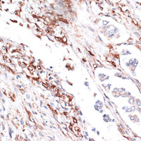 Immunohistochemistry of paraffin-embedded Human lung cancer using Vimentin Polyclonal Antibody at dilution of 1:100 (40x lens) .