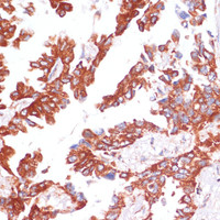 Immunohistochemistry of paraffin-embedded Human lung cancer using Caspase-9 Polyclonal Antibody at dilution of 1:100 (40x lens) .