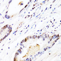 Immunohistochemistry of paraffin-embedded Human colon carcinoma using FGF12 Polyclonal Antibody at dilution of 1:150 (40x lens) .