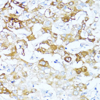 Immunohistochemistry of paraffin-embedded Human liver cancer using SERPINA3 Polyclonal Antibody at dilution of 1:100 (40x lens) .