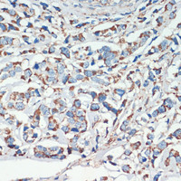 Immunohistochemistry of paraffin-embedded Human breast cancer using APC Polyclonal Antibody at dilution of 1:200 (40x lens) .